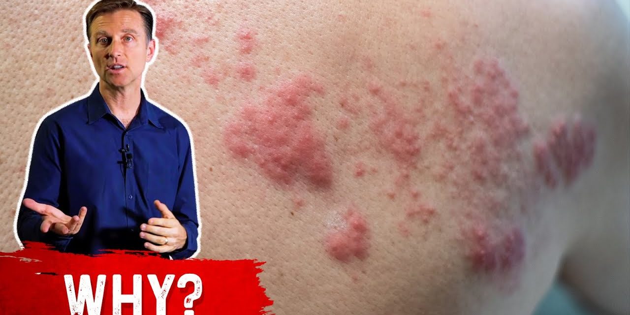 Eczema and shingles