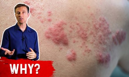Eczema and shingles